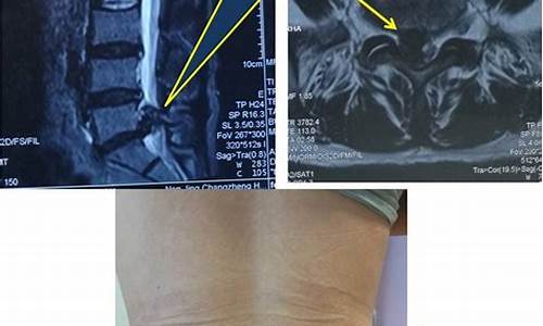 体坛医院腰间盘突出_体坛医院腰间盘突出手术费用